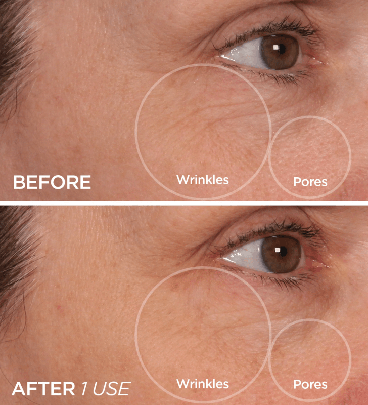 Cryo-facials - The Iceberg 50L is a high-performance localized cryotherapy system designed to apply ultra-cold nitrogen vapor to specific areas of the body for rapid therapeutic effect. Using a built-in 50L liquid nitrogen tank, the system delivers vapor at approximately -160°C (-256°F) with zero humidity, instantly triggering a physiological response on the skin. This rapid exposure to extreme cold causes vasoconstriction (narrowing of blood vessels) followed by reactive vasodilation, resulting in increase